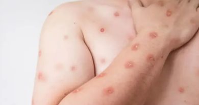 Brasil registra 48 casos de mpox nos primeiros meses de 2026