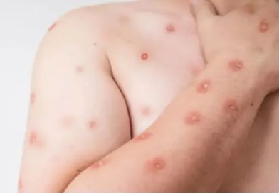 Brasil registra 48 casos de mpox nos primeiros meses de 2026